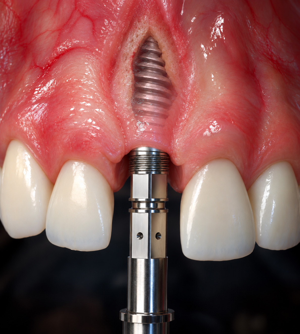 Close-up dental implant placement animation